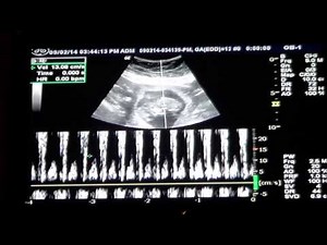 Baby 12 Week Ultrasound & Heartbeat