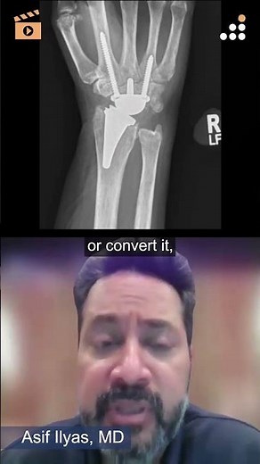 Managing Complications in Modular Wrist Arthroplasty: Revision vs. Fusion