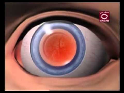YAG laser capsulotomy After Cataract