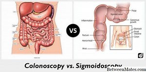 Sigmoidoscopia y Colonoscopia - SALUD 2026