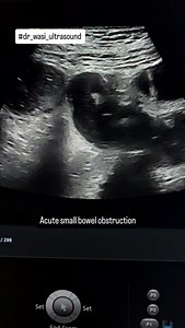 3.9K views · 329 reactions | Intestinal obstruction #smallbowelobstruction #intestinalobstruction #dr_wasi_ultrasound #radiologist #ultrasonography #ultrasonography #neetpg #medicaleducation #abdominalultrasound #ultrasounds #radiologie | Ultrasound made easy | Facebook