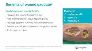 Challenges of Exudate Management Join WOC nurse Dorothy Doughty to explore the challenges associated with exudate and discuss various dressing options for the management of exuding wounds. Learn how different dressing types play a role in creating an optimal wound healing environment, and discover how a conforming foam dressing can help address dead space and exudate pooling. http://ed.gr/94rt | WoundSource