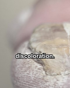 Here’s a secret hack for nail fungus that many don’t know. Don’t have to suffer from harmful products or waste your time on home remedies. Use EMUAIDMAX® for nail fungus. Try EMUAIDMAX® Today - https://emua.id/nf-f01 | Emuaid