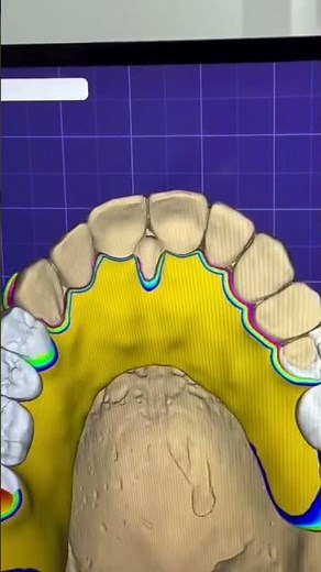 Digital Workflow at its finest CAD/CAM #dentallab #digitaldentistry