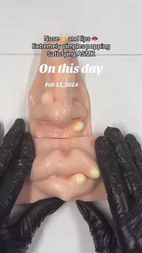 Lips and nose pimple popping #onthisday #nose #lips #asmr #viral #fyp #relax #satisfying #skincare