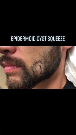 Dr. Pimple Popper Reaction Video | Epidermoid Cyst Squeeze