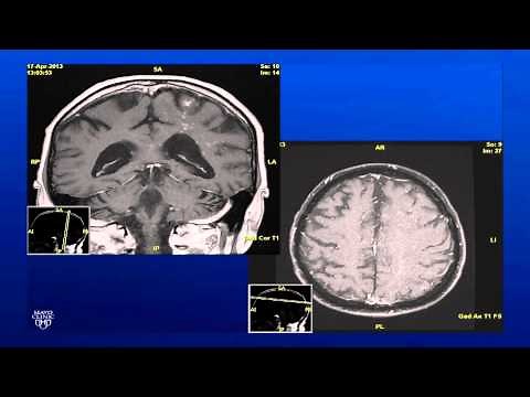 Unilateral Panuveitis
