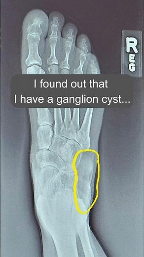 What does a ruptured ganglion cyst look like? #ganglion #ganglioncyst #cyst #cystpoping #foot #lumpy