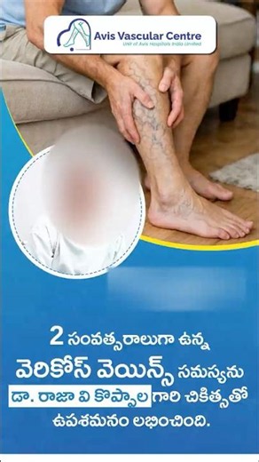 Treating a 10 Year Varicose Veins Problem Without Cuts & Stitches | Avis Hospitals