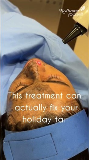 Sun Damage Destroyed by This Hollywood Peel #carbenpeel #tanlremoval #skintreatment