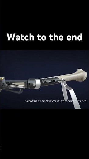 External Fixator for Elbow Injury| Orthopedic Surgery & Recovery Explained #orthopedicsurgery #elbow