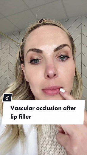 Understanding Lip Filler Complications: Symptoms, Nerves, and Vascular Occlusion