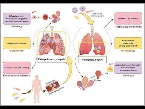 Edema due to alveolar wall injury; when alveolar capillary barrier is damaged