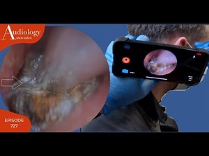 EXTREMELY DIFFICULT EAR WAX REMOVAL - WITH PATIENT VIEW - EP727