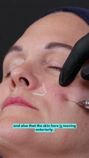 Evidence-Based GEM© Filler Injection Techniques for the Pyriform Fossa - Live Case Study