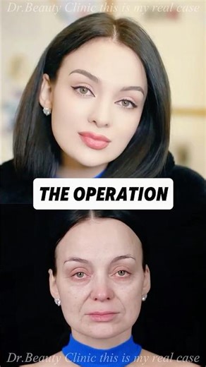 Micro-incision lift delivering natural tightness—simple and clean. #MiniLift #antiaging