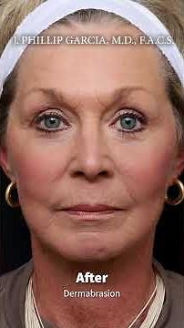 Methods of Skin Resurfacing