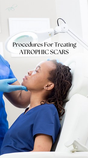 Atrophic scars specifically refer to scars by a loss of collagen and can be challenging to treat. They appear as depressions or indentations in the skin. Procedures for Treating Atrophic Scars include: - Micro-needling: Stimulates collagen production, aiding in scar improvement. - Subcision: This involves inserting an incision beneath the scar to release it from underlying tissue. It’s especially effective for active scar treatment. - Chemical Peels: TCA cross, a potent acid, is applied to deep 