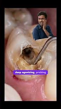 “What Happens When Tooth Decay Progresses? #oralhealth #dentist #drajay #bestdentalcare