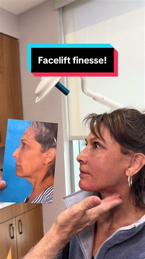 Facelift Finesse: Expert Before & After Transformations