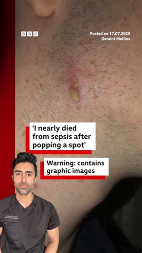 Kunal Sood, MD on Instagram: "Would you still pop that pimple if you knew where it could lead? Most heal fine, but in rare cases, bacteria can spread and trigger sepsis. It moves fast, and early signs aren’t always dramatic. vc: @bbcnews Follow @doctorsoood to improve your health IQ and for similar content. #pimplepopping #sepsis #skininfection #dermatology #healthtips"