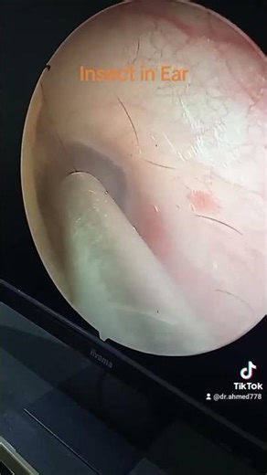 insect in ear near eardrum #removed #satisfying #ent