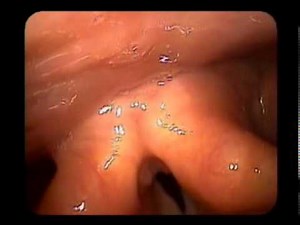 Vocal Cord Cyst (before surgery)