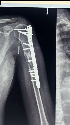 Comminuted shaft Humerus fracture