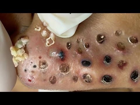 Blackhead Removal With Sac Dep Spa @100074837