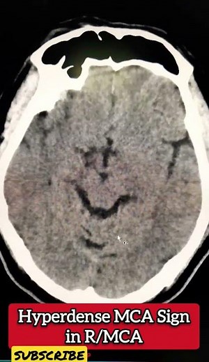 Hyperdense MCA Sign in CT - Radiology
