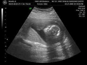 16 Week Ultrasound
