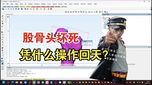 股骨头坏死治疗方案教学（旋转截骨案例1）
