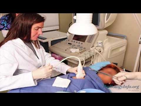 Your Radiologist Explains: Ultrasound-guided Breast Biopsy