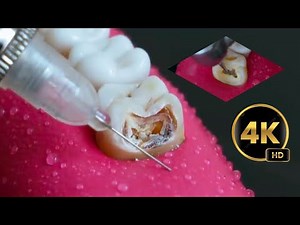 Tooth Cavity Restored: Root Canal & Composite Filling