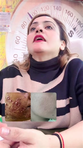 Nisha Lamba on Instagram: "Acne Care ☎️ 7053989332 Add- CSC Market, Sec-18B, Dwarka, New Delhi - 110078 #Facial #Skincare #BeautyTips #GlowUp #facialtreatment"