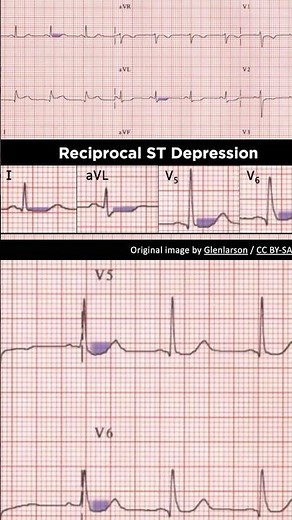Acute Inferior STEMI ECG: Reciprocal ST depression