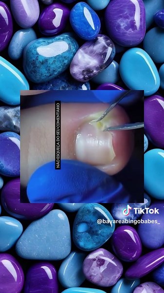 Effective Treatments for Fungal Nail Infections