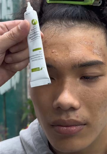 Gel chấm mụn giảm thâm, trị mụn bọc mủ viêm - hiệu quả sau 1 tuần