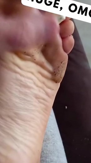 Pimple Squirt Compilation | Long Videos for Pimple Popping Fans