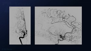 #350: Superficial Temporal Artery to Middle Cerebral Artery Bypass for Moyamoya Disease - Bypass - Seven Series Collection
