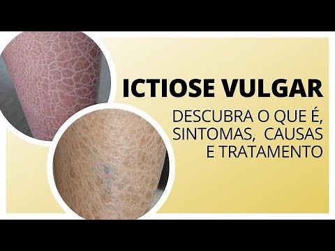 Ictiose vulgar - Descubra o que é, sintomas, causas e tratamento