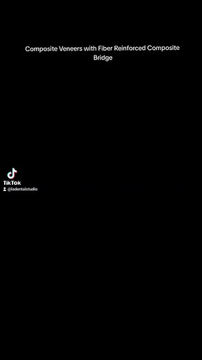 3.5K views · 30 reactions | Composite Veneers + Fiber Reinforced...