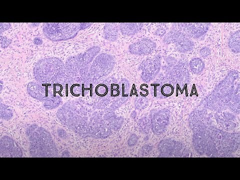 Trichoblastoma (mimic of basal cell carcinoma) skin adnexal tumor hair follicle tumor pathology