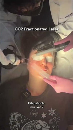 Treating Mild Acne Scars #BoxcarScars #RollingScars