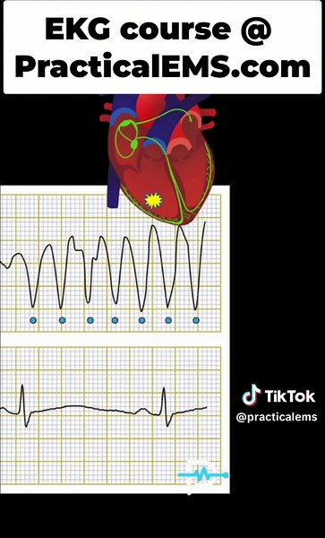 Identifying Hallmarks of Ventricular Tachycardia