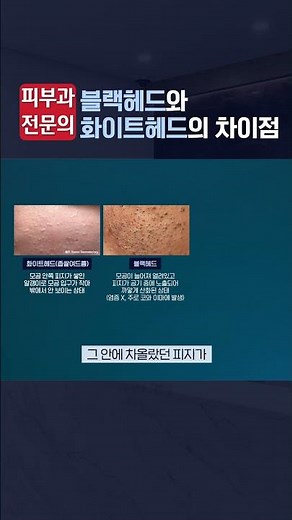 블랙헤드와 화이트헤드, 차이! #영종도피부과