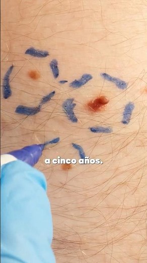 Cancer de Piel: ESTADÍSTICA