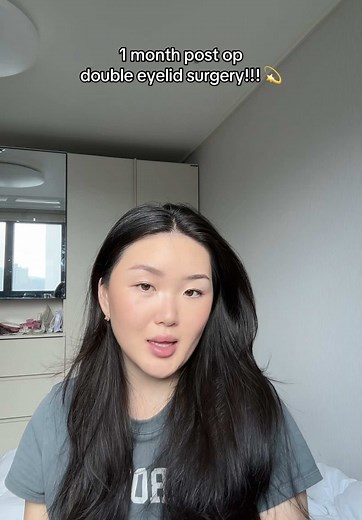 Double Eyelid Surgery: One Month Post-Op Results