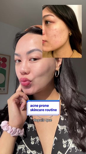 Soins pour peaux sensibles : Duo Effaclar en action