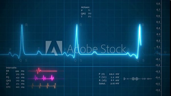 Electrocardiogram - pulse trace ,EKG Patient Heart Monitor Screen with Vital Signs, oxygen respiration ,Medical examination. 4K video footage animation. Cardiac monitoring. Electrocardiography